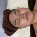 오넬 | 예비신부 피부관리 배방 오넬뷰티 수분관리 후기 (홍조피부+비립종 제거)