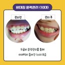 맨손자연성형