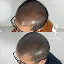 신월동214 | 탈모 커버 효과 최고! 신월동 두피문신 SMP란?