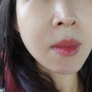 피코헬스케어 | [나비존 모공시술, 피부과 모공주사] 쥬베룩,포텐자 들어간 모공흉터프로그램 1회차 솔직후기