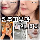 세븐일레븐진주상대대로점 | 진주피부과 리니어지 500샷 리프팅 생생후기