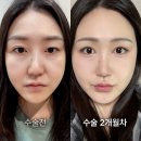 드라마성형외과의원 | 30대 처진 눈매 고민 절개쌍수+눈매교정 2개월차 후기 | 논현 드라마성형외과