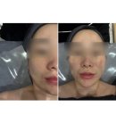 뷰티에이 | 천안 불당동피부관리 뷰티에이에서 받은 인퓨즈웨이브 후기