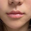 오목내 | 인중오목술 6개월차 후기 (feat. 부작용, 인중리프팅?, 흉터)