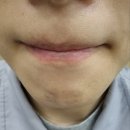 [인천] :: 레이저 제모 13회차 솔직 후기 #남자도관리해야할때 #레이저제모13회차
