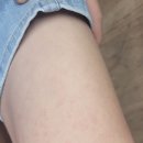 아이 몸좀 봐주시겠어요..;;.(두드러기 일까요?) 이미지