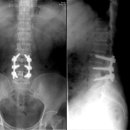 척추관협착증(Spinal stenosis) 이미지
