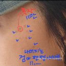 코스모의원 | 1주일만에 흑자 제거 후기| 흑자 제거 비용 &amp; 병원(흑자관리팁)