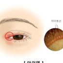 눈염증 안검염 , 눈기름샘 청소 (눈꺼풀 여드름, 눈에기름, 마이봄샘) 이미지