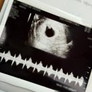 돈돈상무점 | 임신 6주차 7주차 기록 : 앙즈로산부인과 심장소리확인·입덧증상·입덧완화음식