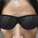 세연약국 | 세연한의원에서 편평사마귀 무제한 제거 2번, 속 시원해