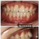 예스안치과의원 네이버블로그