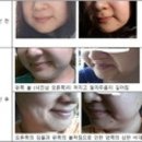 동백미즈한의원,쉬즈한의원 안면비대칭 상담후기