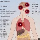 코로나 후유증으로 인한 폐 기능 저하를 기능의학적 치료로 회복한 사례 보고를 본 후기 이미지