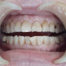 한양기공사 | 60대 라미네이트후기 - 명동 한번에치과