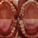 울산스마트치과의원 | 어금니 잇몸뼈가 부족하면 어떻게 임플란트 하나요? - 병영 울산스마트치과