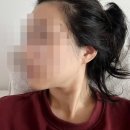 인천 사각턱보톡스 리엔장의원 내돈내산 후기 당일붓기 가격 전후사진 효과