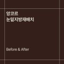 백피부과의원 | 구도피부과 앙코르 눈밑지방재배치 후기