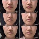 청담동피부과 서울대 피부과 전문의 메타셀 MCT 줄기세포 자가엑소좀 관리 후기