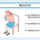 목디스크 원인 방법 이미지