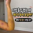 (주)한국바이오정보 | 팔 지방흡입 붓기 빠지는 과정부터 바이오본드 후기까지