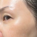 하오덤의원 | 압구정 하오덤의원에서 덴서티(DENSITY) 시술 3주 차 후기 늦은 기록