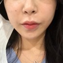 역삼성형외과 바노바기 쁘띠클리닉 반쪽주사 후기