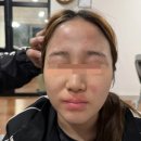 코앤유의원 | 아토피 및 알러지 치료 후기, 2편