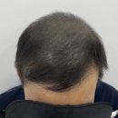 림스칼프 이미지