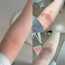 임산부 아토피 소양증 극복 과정 : 락티케어 임산부 연고 처방 후기 / 내돈내산 보습 크림 추천