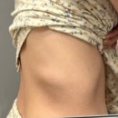 용인항유외과의원 | 용인 지방종 당일제거 후기 ㅣ용인항유외과에서 지방종수술