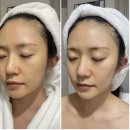 황토지오 - 870 | 엘피지오 목동점에서 팔자주름 심부볼 해결한 솔직 후기 | 오목교 피부과 추천