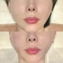 스피드프라자 | 계산동피부관리웨딩 스피드 윤곽 케어 탐날에스테틱 후기