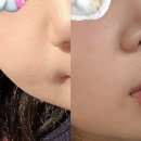 팔자 땜에 시술 받아봤는데 이미지