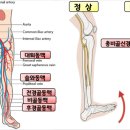 종아리 근육 긴장도(말미잘 안되는 아이들) 이미지