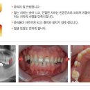 영등포 임플란트/당산동 임플란트 - 임플란트의 장점은 무엇일까요? 이미지