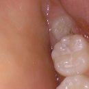 리볼리치과의원 | 오리역 사랑니 발치 후기, 무서웠지만 생각보다 편했던 ‘리볼리치과의원’