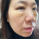 김동물병원 인공수정소 | 눈밑지방재배치 수술후기 - 수술전~10일까지 리얼후기