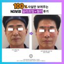 대전 둔산동 필러 후기 이마 미간 주름 해결 방법 (feat. 르네필)