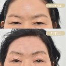 연세브이의원 | 눈썹 실리프팅 전후 사진 (Feat. 민트실리프팅) 가격, 부작용, 후기 [망포역 연세브이의원]