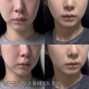 페이스 | 압구정 튠페이스 후기 | 통증 효과 부작용 총정리