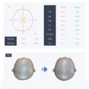 (집)이마트24광명소하람점 | 사두 단두 두상교정일기⑤ 비바3D헬멧 착용 후기 | 6개월 아기 헬멧 적응(2달차)| 2차 수정결과 공유