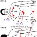 부항 - 위장 질환의 부항 이미지