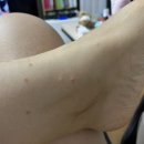 전세정독일피부과의원 네이버블로그