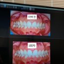 경산라온치과병원 | 경산 치아 미백 3회 후기｜사진 찍을 때 신경 쓰였던 치아 톤 변화