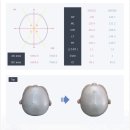 수정-93 | 단두증 두상교정 헬멧 5주 수정 후기 | Viva 비바헬멧 위례 (수치 변화 공개)