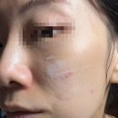 더블유메디 | 뒤집어진 여드름 트러블 피부에 메디제이 더블유크림 솔직 후기!