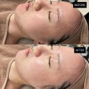 (주)바디프랜드 인천검단 | 검단 불로동 피부관리 기미 “비비드엘 인천점” 케어 리뷰 후기 (+케어 전/후 사진)