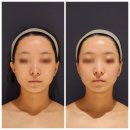 얼굴 | 마곡신부관리 마곡오브미 에스테틱에서 얼굴축소 후기, 웨딩준비