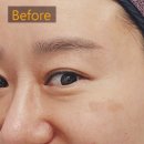새론바이오 | [인천논현 바이오셀후기] 40대 피부 고민/기미,흑자제거 전 피부재생치료부터!